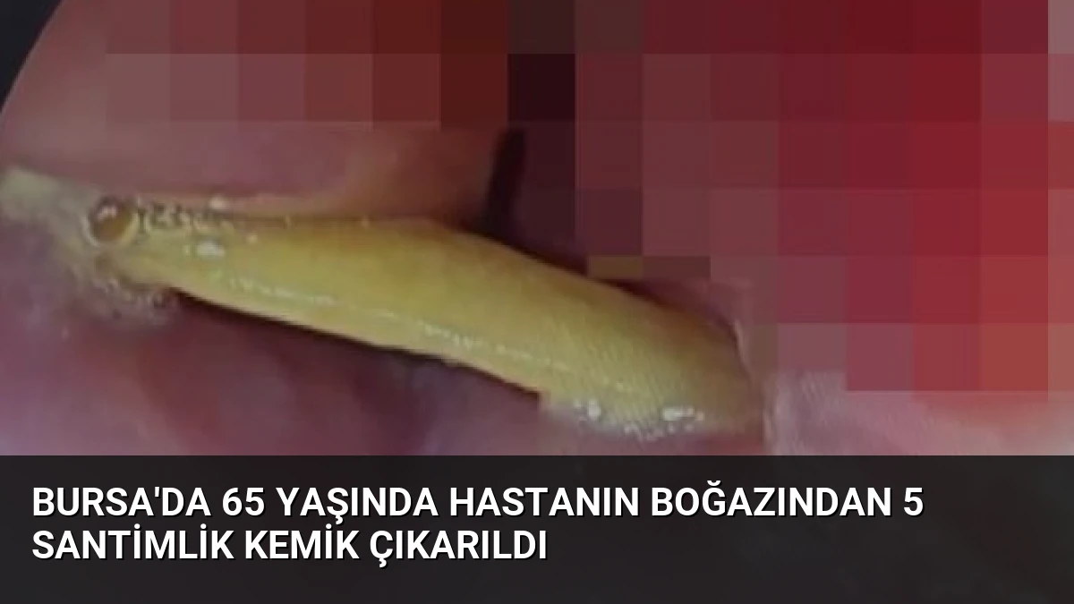 Bursa’da 65 Yaşında Hastanın Boğazından 5 Santimlik Kemik Çıkarıldı