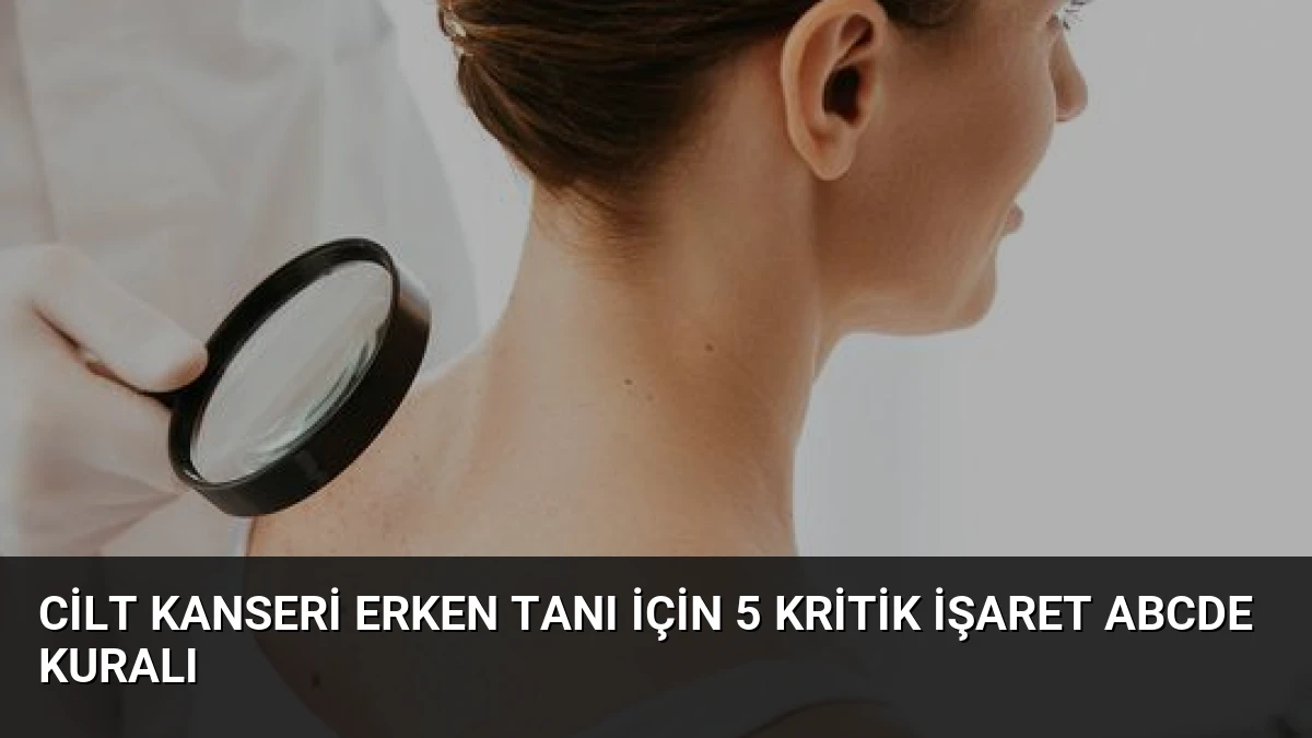 Cilt Kanseri Erken Tanı İçin 5 Kritik İşaret ABCDE Kuralı