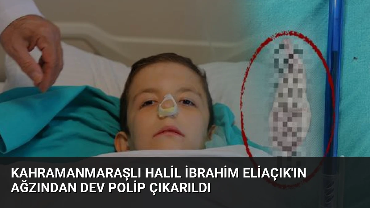 Kahramanmaraşlı Halil İbrahim Eliaçık’ın Ağzından Dev Polip Çıkarıldı