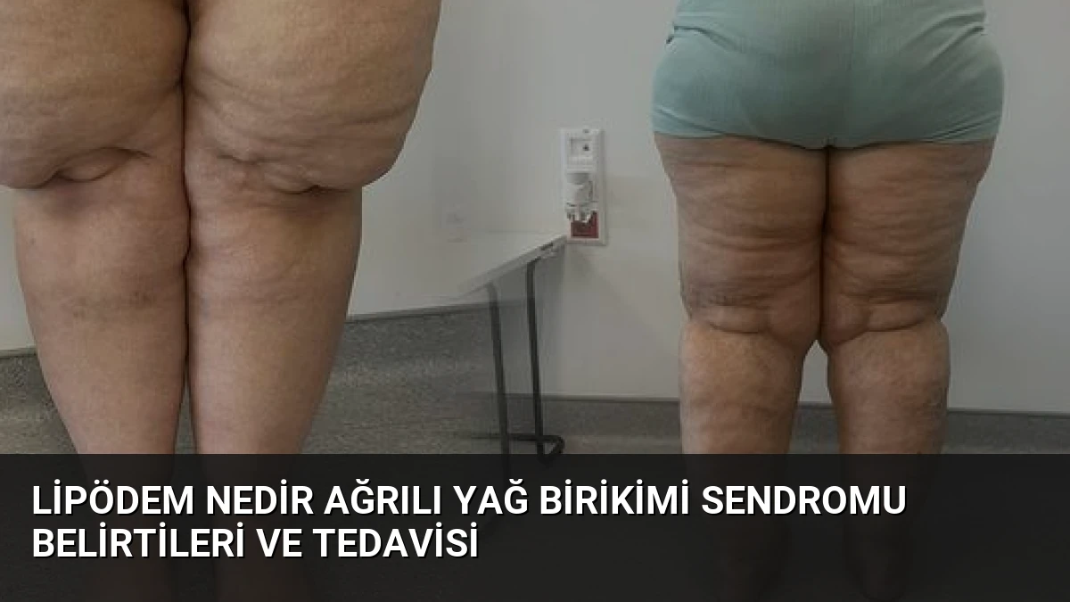 Lipödem Nedir Ağrılı Yağ Birikimi Sendromu Belirtileri ve Tedavisi